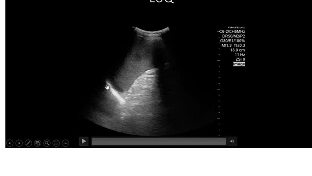 Lefq Upper Quadrant scan in FAST Scan