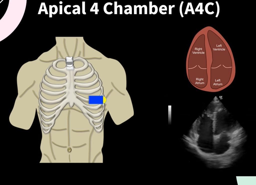 Apical Four Chambers View and Anatomy in Echocardiography