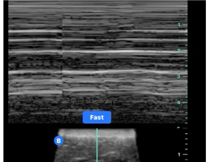 Barcode sign in M Mode during Lung Ultrasound which can signifies pneumothorax