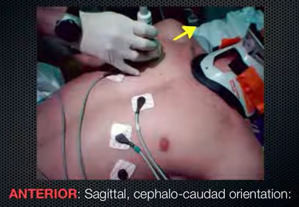 Lung Ultrasound Probe Placement