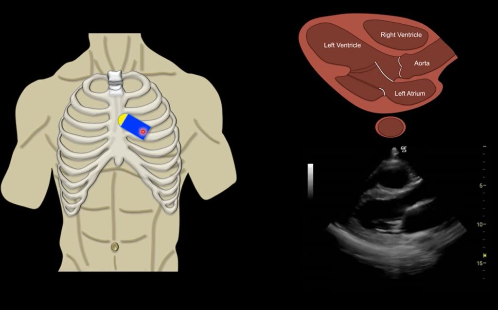 Parasternal Long Axis Echo Probe Position and Anatomy