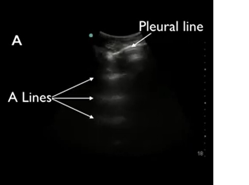 Lung Ultrasound showing reverberations