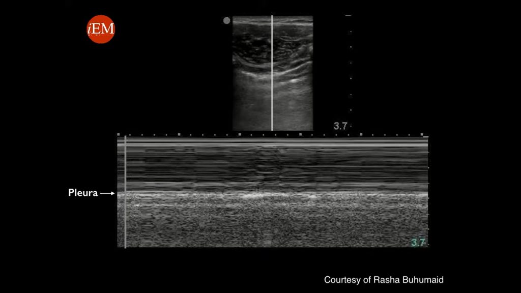 Seashore sign in M Mode in Lung Ultrasound