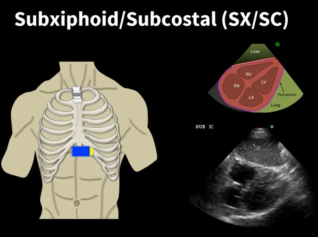 Subxiphoid Probe Placement and Anatomy in Echocardiography